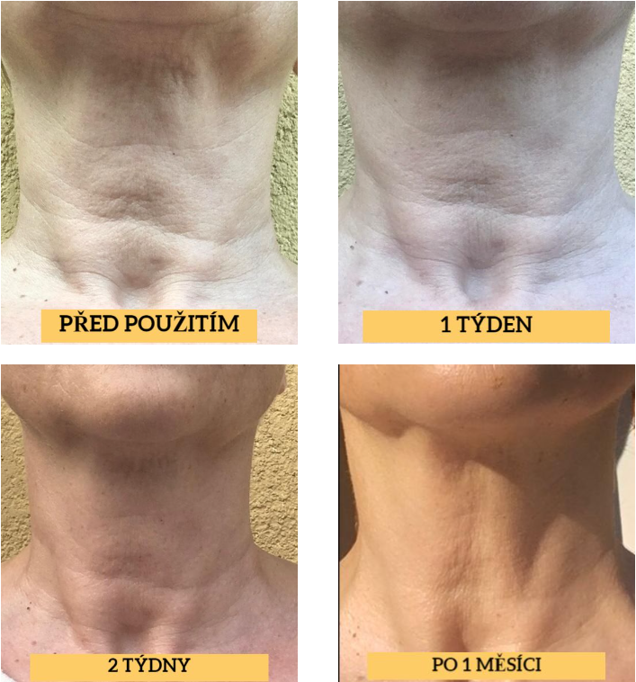 Vrásky na krku, předtím a potom